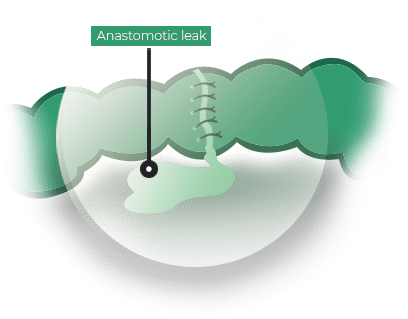Προφυλακτική Ειλεοστομία - Ενδείξεις