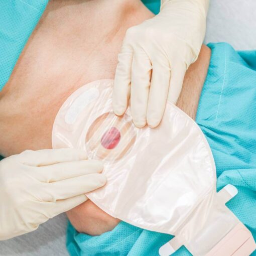 Προφυλακτική Ειλεοστομία – Ενδείξεις