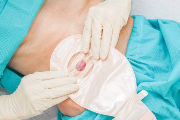 Προφυλακτική Ειλεοστομία – Ενδείξεις