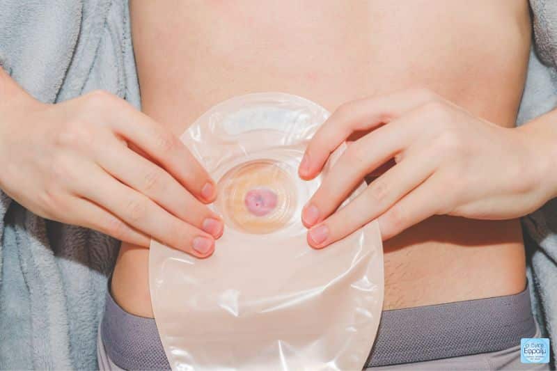 Προφυλακτική Ειλεοστομία - Ενδείξεις