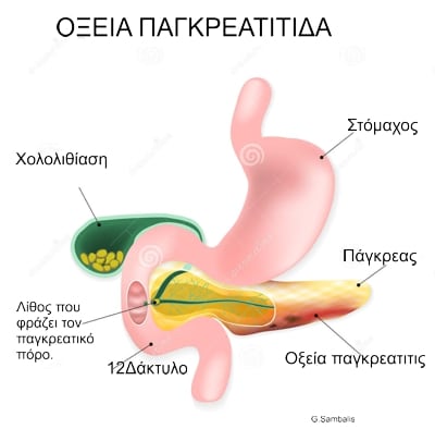 Οξεία Παγκρεατίτιδα: Πόσο επικίνδυνη είναι