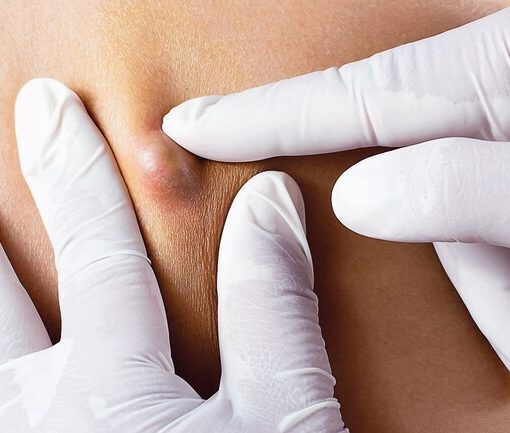 Σμηγματογόνος κύστη