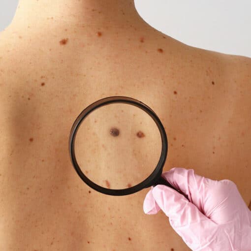 Μελάνωμα δέρματος