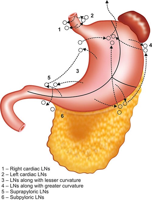 Λεμφαδενεκτομη στομαχου