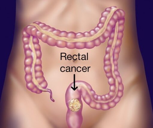 καρκίνος του ορθου