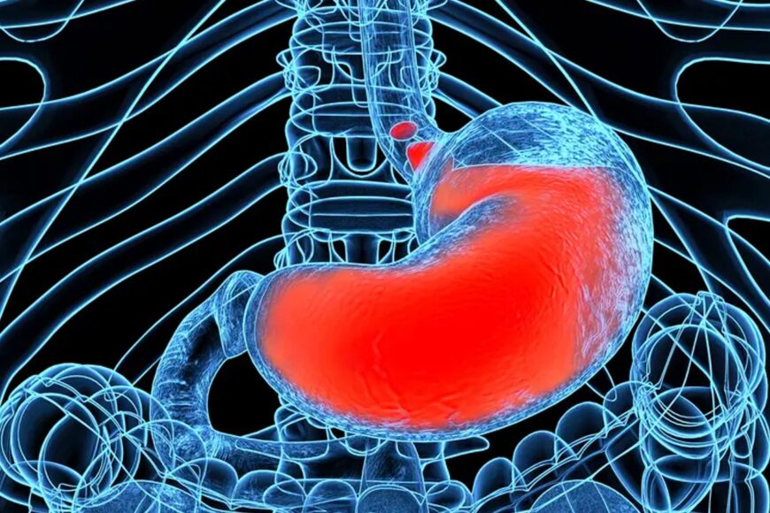 Γαστροοισοφαγικη παλινδρόμηση