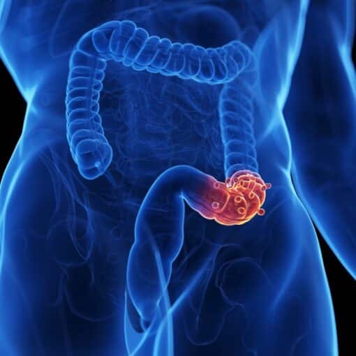 Εκκολπωματίτιδα