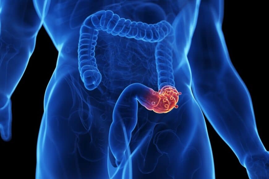 Εκκολπωματίτιδα