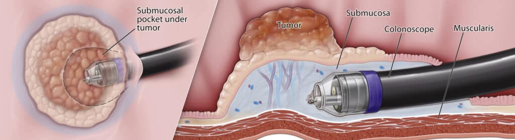 ESD (Endoscopic Submucosal Dissection – ενδοσκοπική υποβλεννογόνια εκτομή)