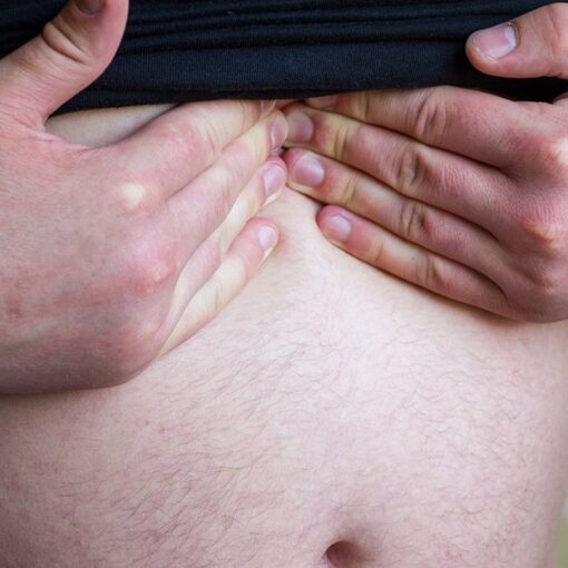 Επιγαστρική κήλη