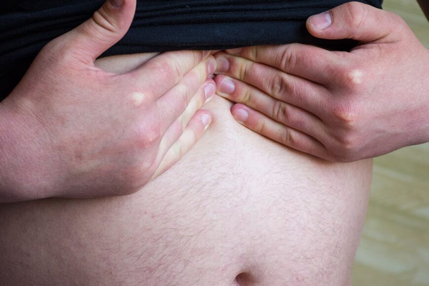 Επιγαστρική κήλη