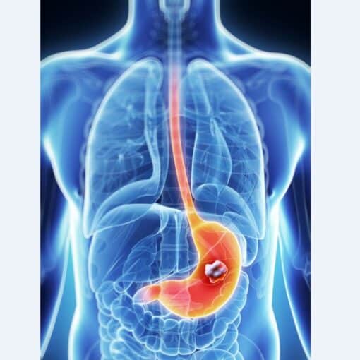 Καρκίνος στομάχου – οδηγός ασθενούς