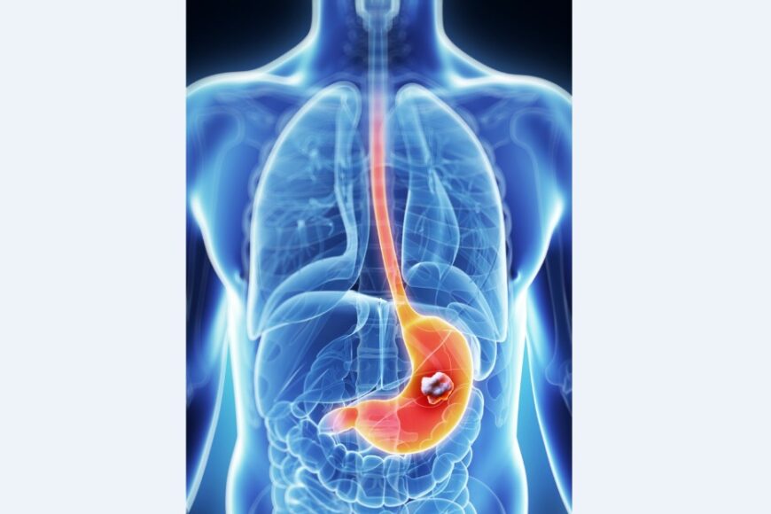 Καρκίνος στομάχου – οδηγός ασθενούς