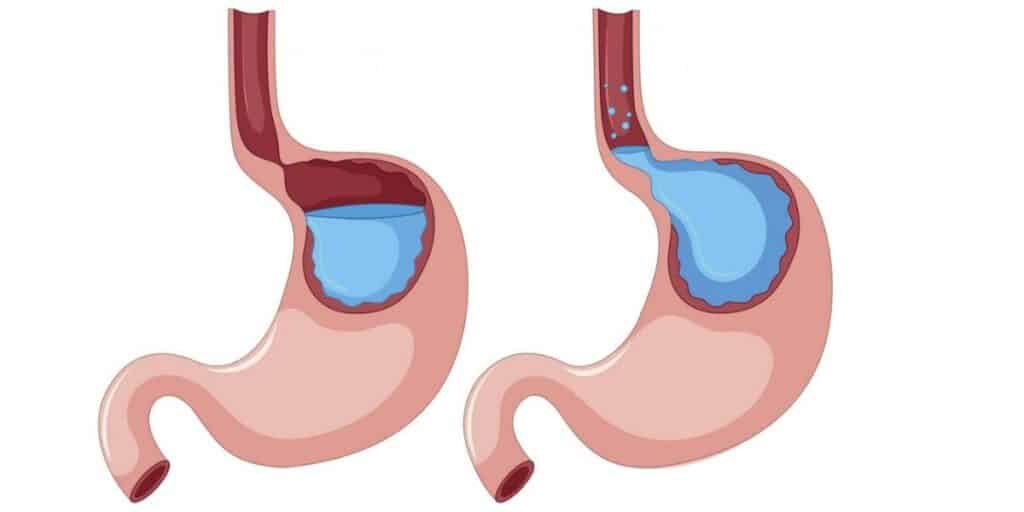 Γαστροοισοφασγικη παλινδρόμηση