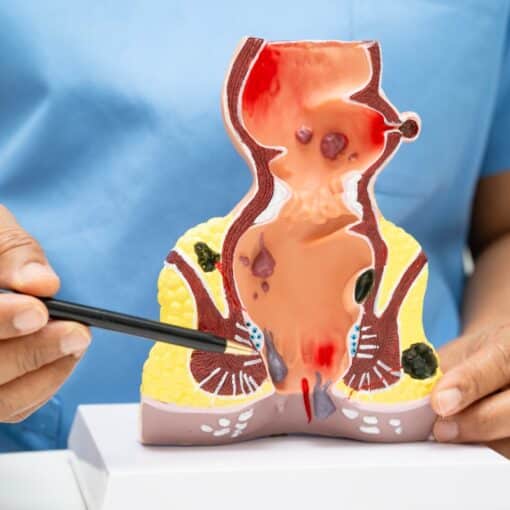 Αιμορροιδες