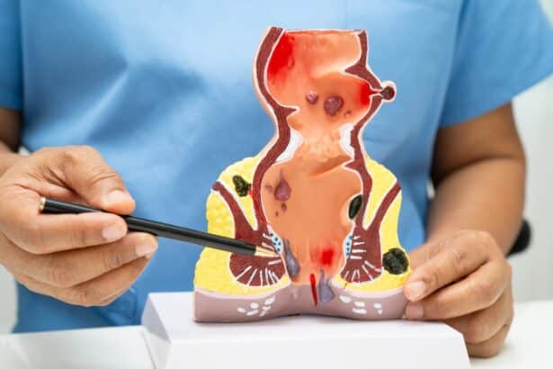 Αιμορροιδες