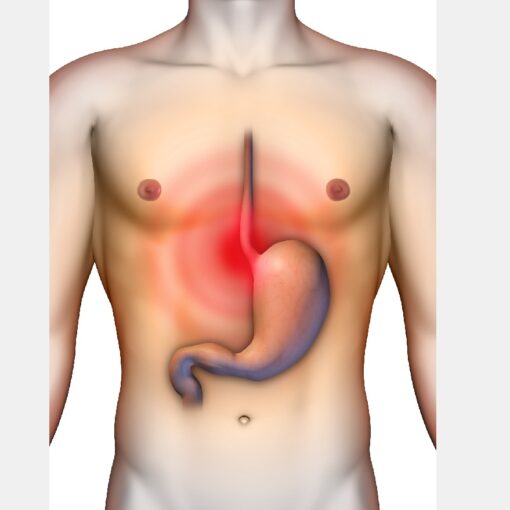 Διαφραγματοκήλη