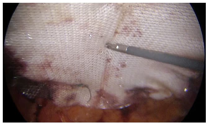 Λαπαροσκοπική ipom