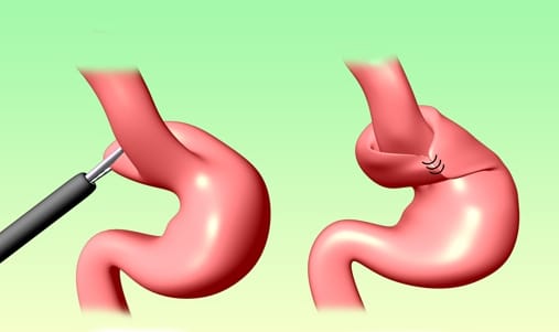 Nissen θολοπλαστική