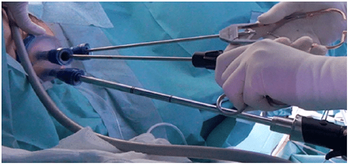 TAMIS (Transanal Minimally Invasive Surgery – διαπρωκτική ελάχιστα επεμβατική αφαίρεση)
