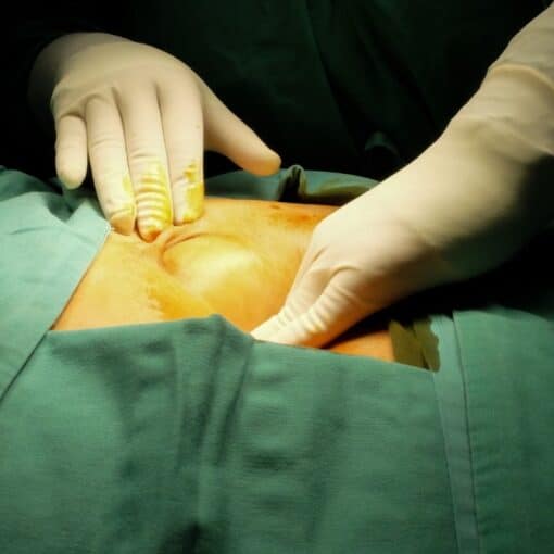 Ομφαλοκήλη