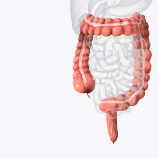 Καρκίνος παχέος εντέρου