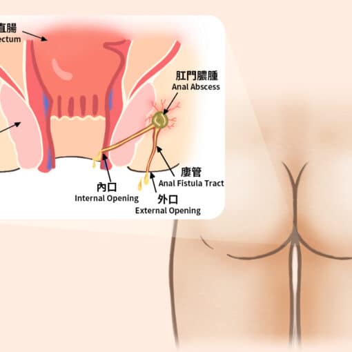 Περιεδρικο Συριγγιο