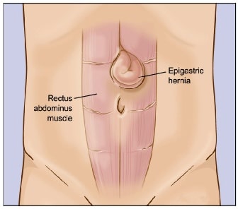 Επιγαστρικη κηλη