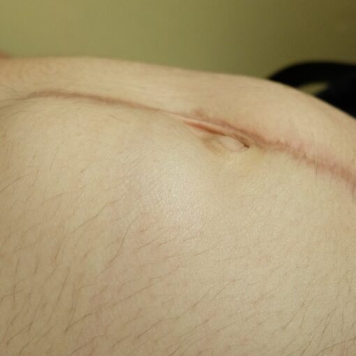 Μετεγχειρητική κήλη