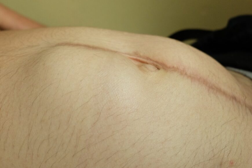 Μετεγχειρητική κήλη