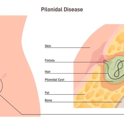 Κύστη κόκκυγις