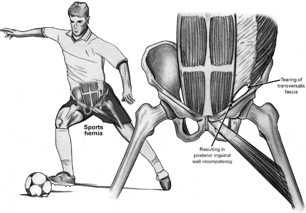Sports |Hernia