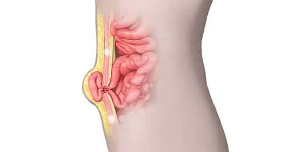 Τι είναι ομφαλοκήλη