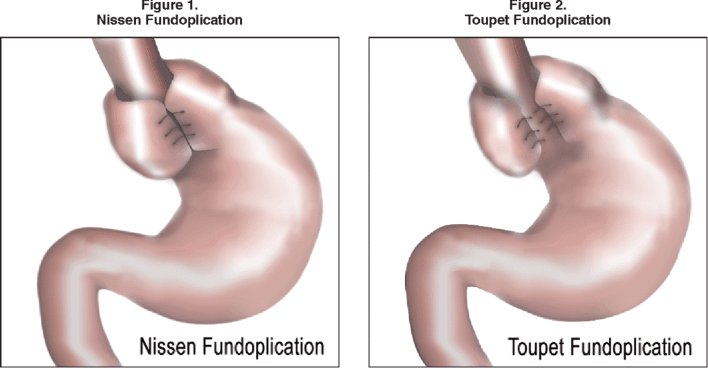 Μέθοδος Toupet