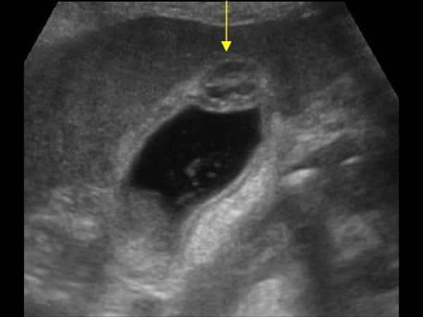 Υπερηχογράφημα άνω κοιλίας