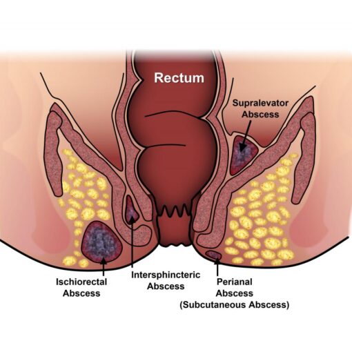 Περιεδρικό απόστημα