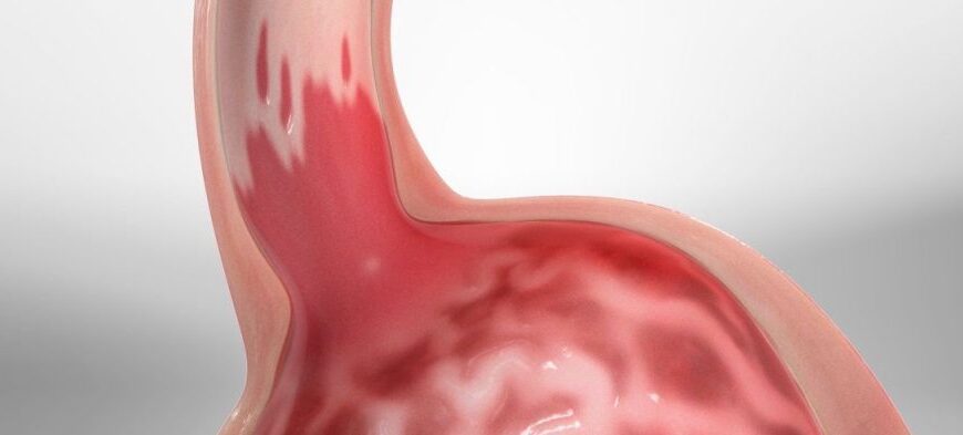 οισοφαγος barrett