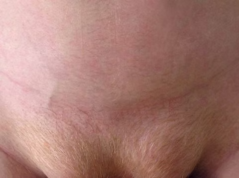 Βουβωνοκήλη άμφω