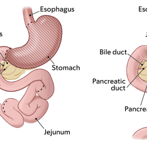 Γαστρεκτομη