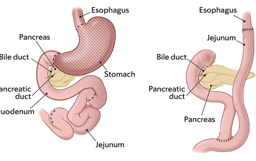 Γαστρεκτομη