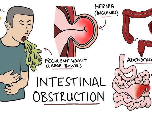 Αποφρακτικος ειλεος