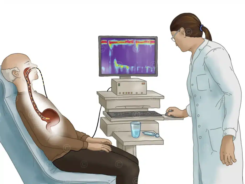 manometry-swallowing-1440x1080 - Γεώργιος Σάμπαλης Μανομετρία οισοφάγου