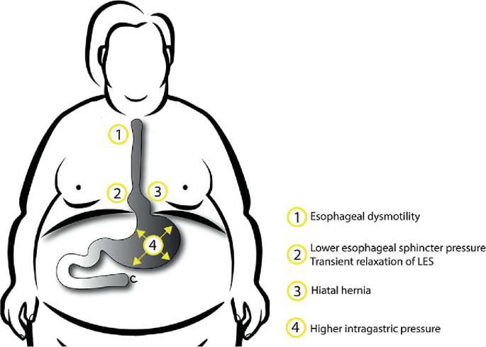 Παχυσαρκία και ΓΟΠ