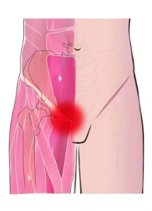 Κήλη των αθλητων