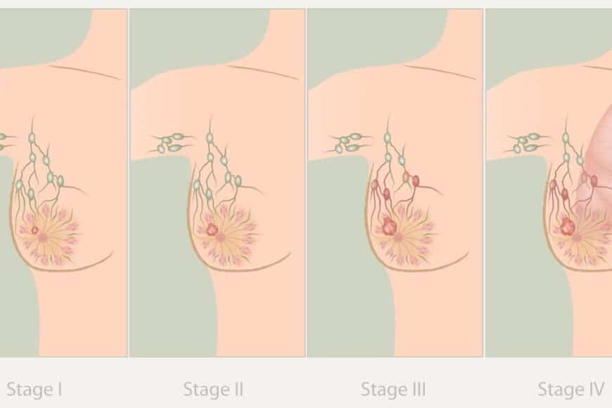 Καρκινος μαστου