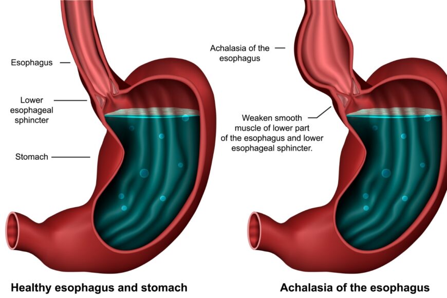 Αχαλασία οισοφάγου