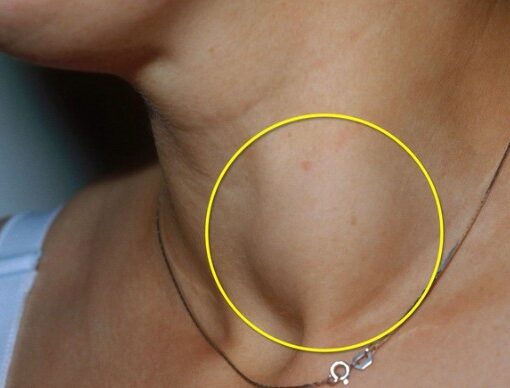 Καρκίνος Θυρεοειδούς