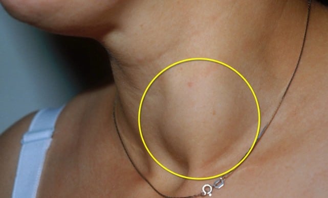 Καρκίνος Θυρεοειδούς