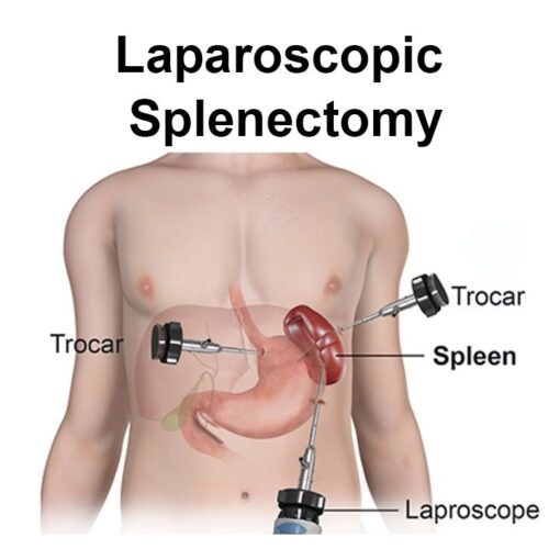 Λαπαροσκοπική Σπληνεκτομη