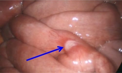 Καρκινοειδες